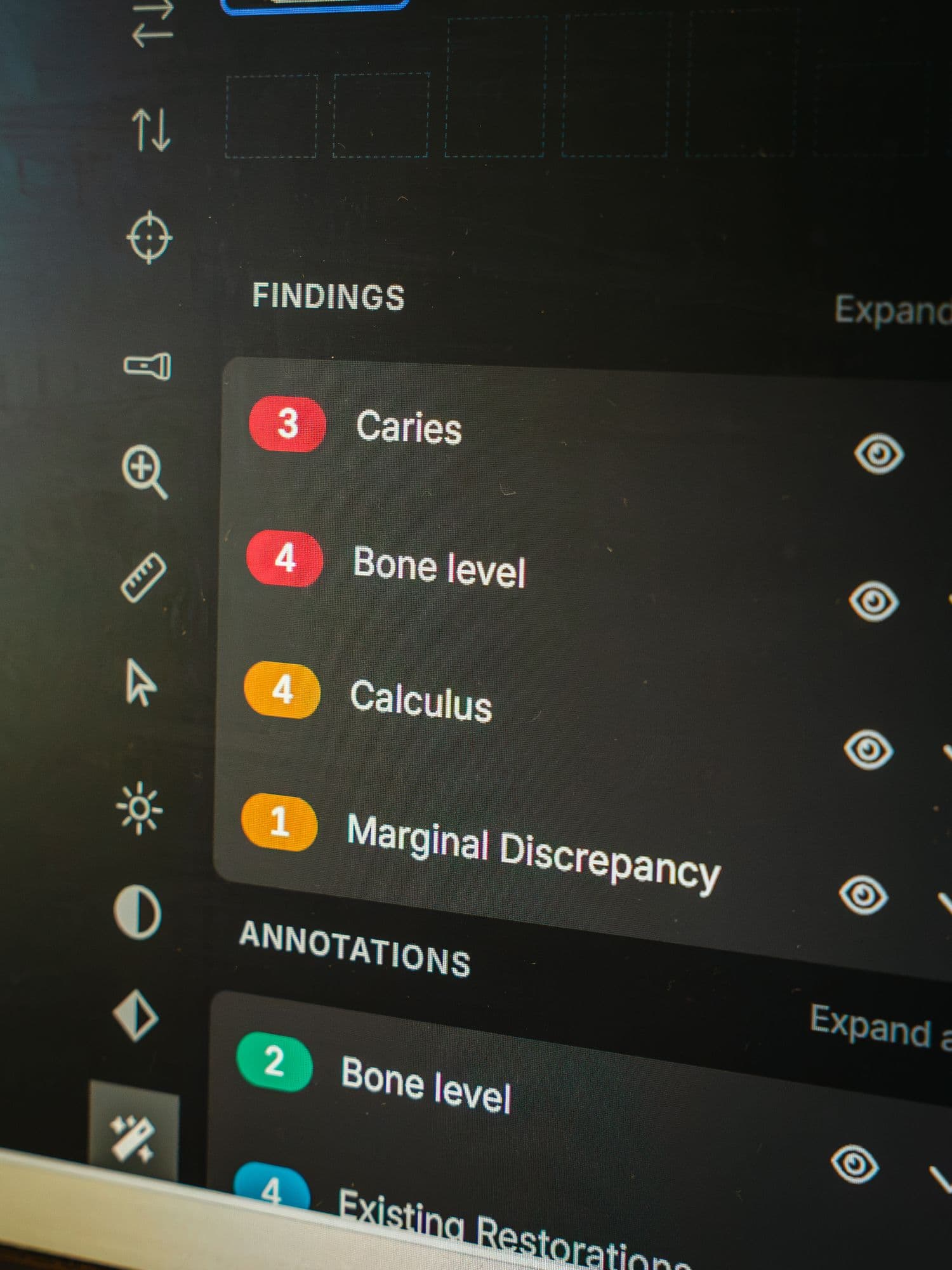 X-ray findings for decay, bone level and calculus reviewed on screen