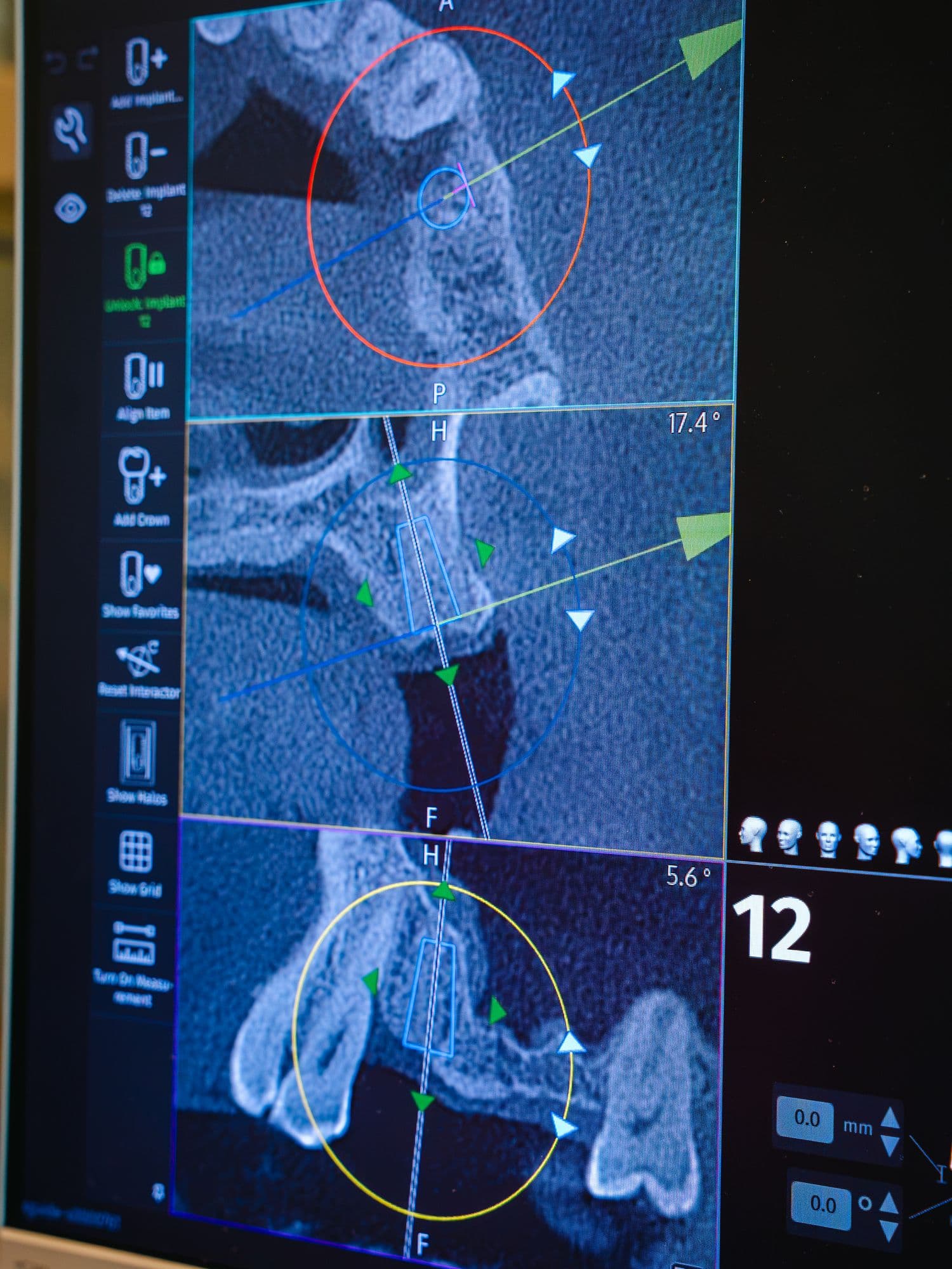 An implant's angle and depth planned on a 3D scan