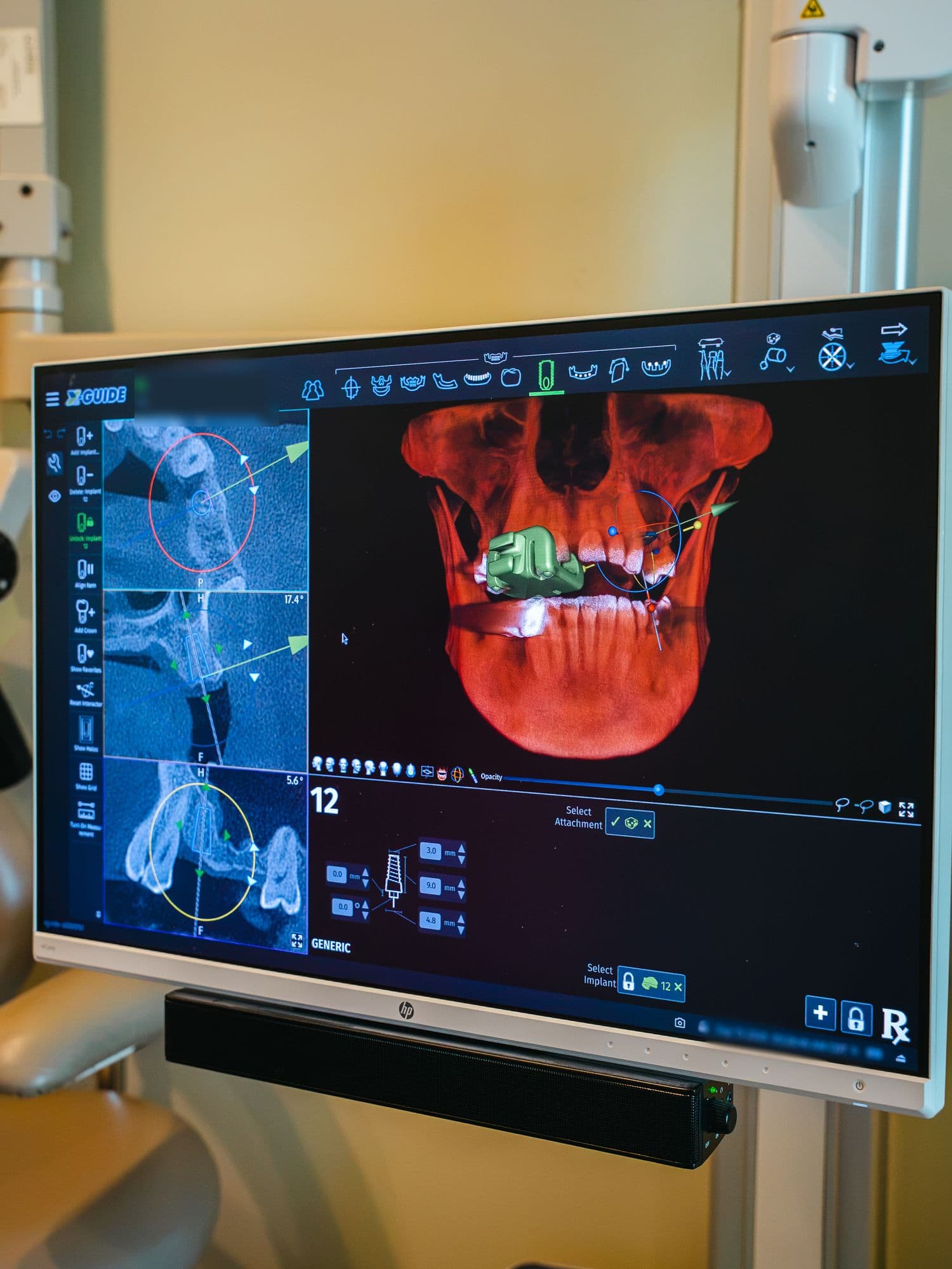 An implant position planned on 3D imaging at Park Place Dental