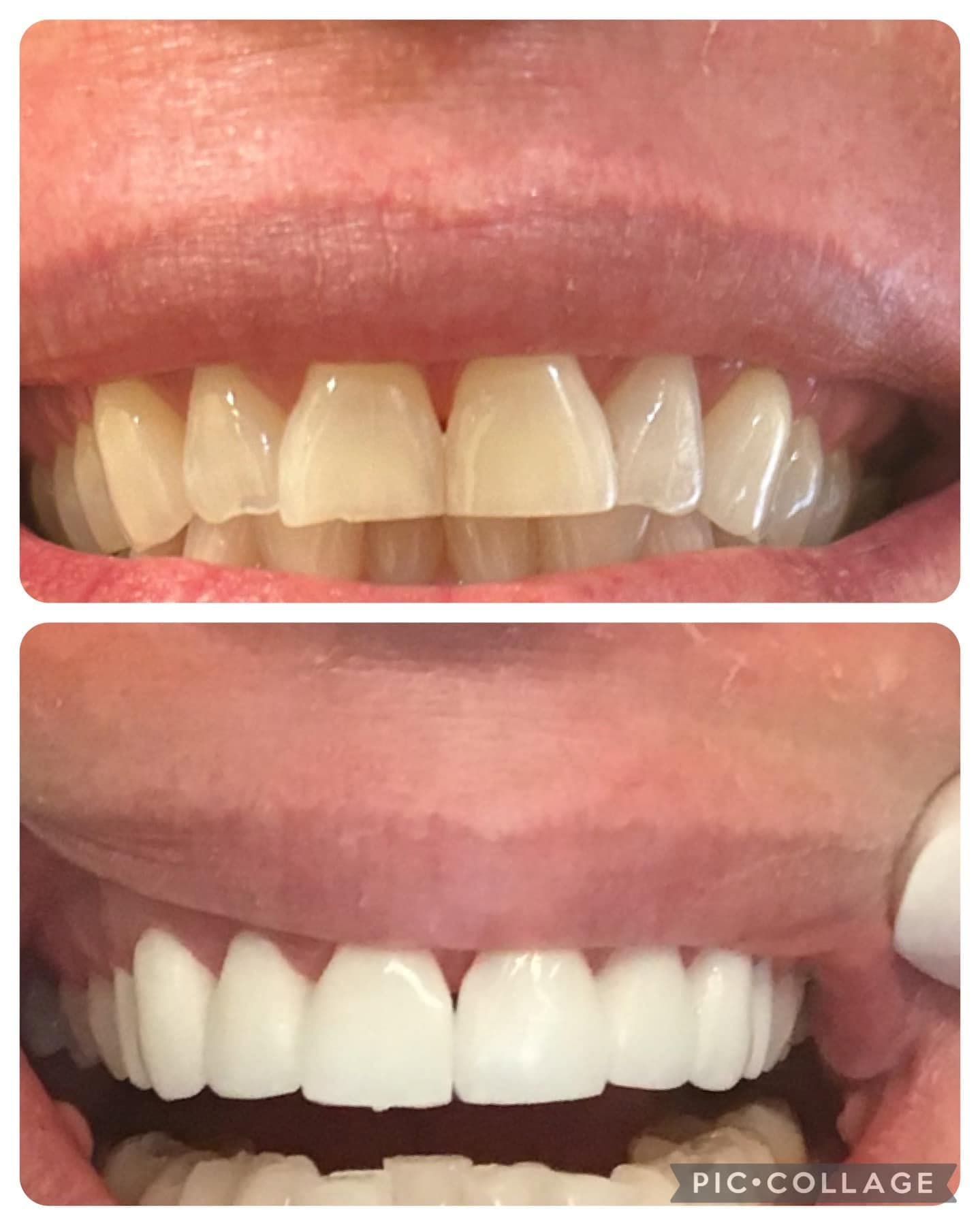 Before and after a cosmetic case at Park Place Dental