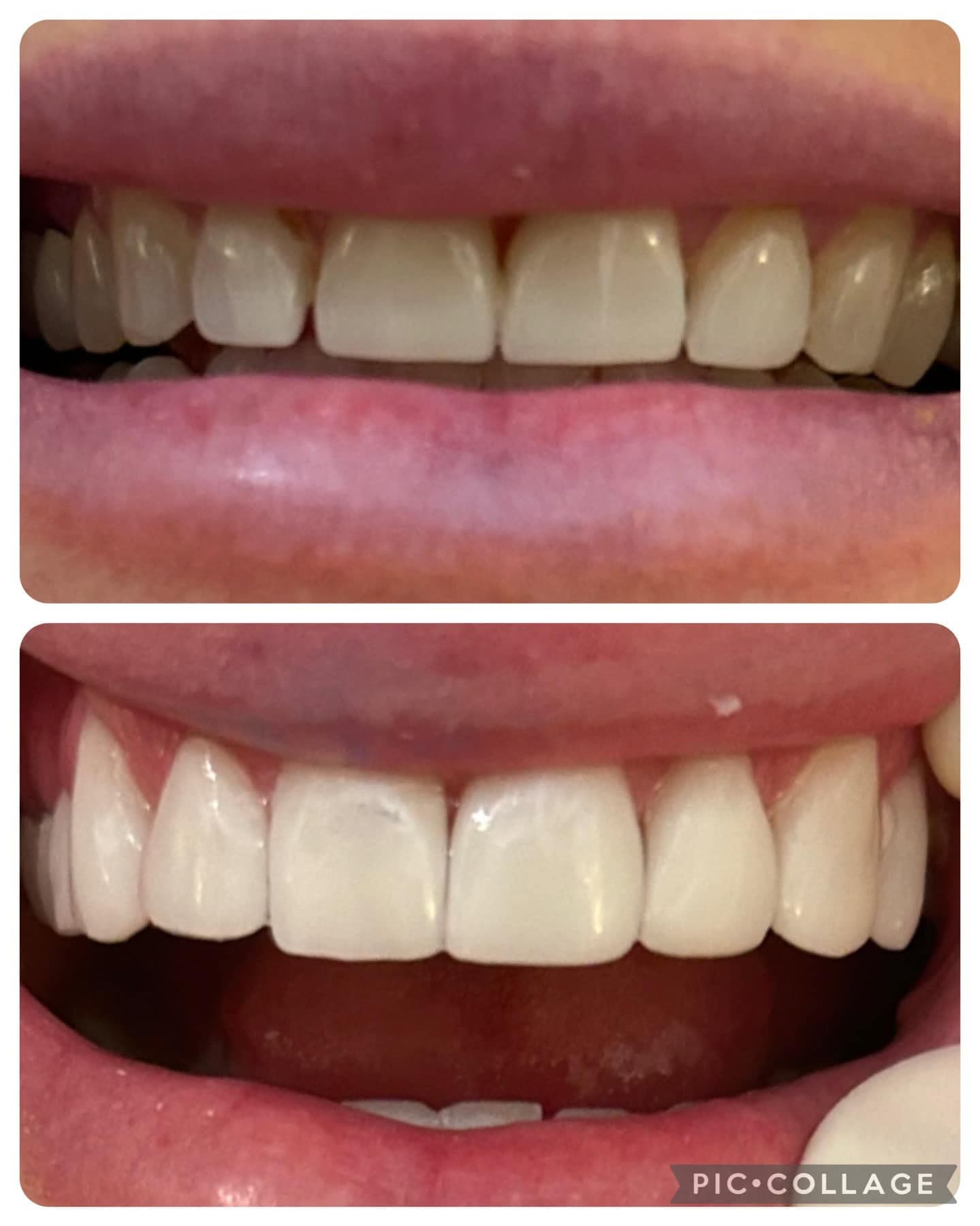 Before and after a second cosmetic case at Park Place Dental